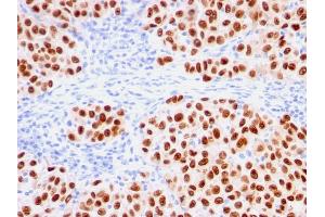 Formalin-fixed, paraffin-embedded human melanoma stained with SOX10-Monospecific Recombinant Mouse Monoclonal Antibody (rSOX10/1074). (Recombinant SOX10 抗体  (AA 115-269))