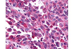 Anti-FZD8 / Frizzled 8 antibody IHC of human Lung, Non-Small Cell Carcinoma. (FZD8 抗体  (N-Term))