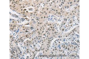 Immunohistochemistry of Human cervical cancer using CDC27 Polyclonal Antibody at dilution of 1:50 (CDC27 抗体)