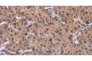 Immunohistochemistry of paraffin-embedded Human prostate cancer tissue using HSD11B2 Polyclonal Antibody at dilution 1:35 (HSD11B2 抗体)