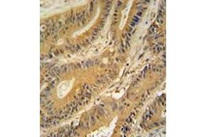 Immunohistochemistry analysis in formalin fixed and paraffin embedded human colon carcinoma reacted with GNAT3 Antibody (Center) followed  which was peroxidase-conjugated to the secondary antibody, followed by DAB staining.