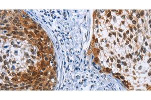 Immunohistochemistry of paraffin-embedded Human cervical cancer tissue using CRABP2 Polyclonal Antibody at dilution 1:40 (CRABP2 抗体)
