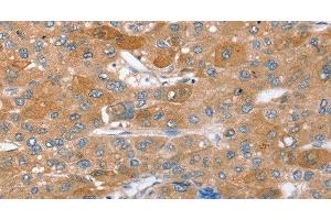 Immunohistochemistry of paraffin-embedded Human liver cancer using STX2 Polyclonal Antibody at dilution of 1:40 (STX2 抗体)