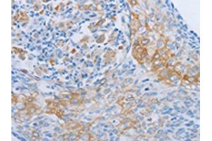 The image on the left is immunohistochemistry of paraffin-embedded Human cervical cancer tissue using ABIN7189704(ADRB3 Antibody) at dilution 1/60, on the right is treated with synthetic peptide.