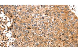 Immunohistochemistry of paraffin-embedded Human esophagus cancer tissue using ABCC9 Polyclonal Antibody at dilution 1:50 (ABCC9 抗体)