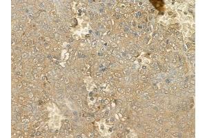 ABIN6264209 and ABIN6272607 at 1/100 staining human melanoma by IHC-P.