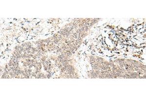 Immunohistochemistry of paraffin-embedded Human esophagus cancer tissue using FAM84B Polyclonal Antibody at dilution of 1:70(x200) (FAM84B 抗体)