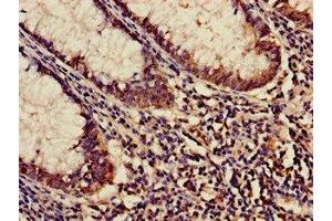 Immunohistochemistry of paraffin-embedded human colon cancer using ABIN7158683 at dilution of 1:100 (KARS 抗体  (AA 101-400))