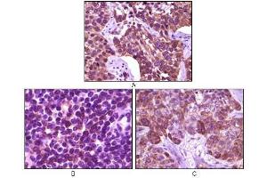 Immunohistochemical analysis of paraffin-embedded human lung carcinoma (A), lymph tissue (B) and skin carcinoma (C), showing membrane localization using BLK antibody with DAB staining. (BLK 抗体)