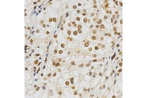 Immunohistochemistry of paraffin-embedded human kidney cancer using Lamin A/C antibody. (Lamin A/C 抗体)