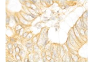 Immunohistochemical staining of Human Intestines Cancer (FGFR2 抗体  (C-Term))
