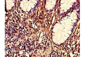 Immunohistochemistry of paraffin-embedded human colon cancer using ABIN7161922 at dilution of 1:100 (NRIP2 抗体  (AA 1-281))