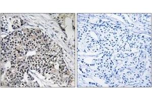 Immunohistochemistry analysis of paraffin-embedded human breast carcinoma tissue, using MRPL24 Antibody. (MRPL24 抗体  (AA 101-150))