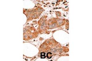 Formalin-fixed and paraffin-embedded human cancer tissue reacted with the primary antibody, which was peroxidase-conjugated to the secondary antibody, followed by AEC staining. (BCL2L14 抗体  (AA 194-229))