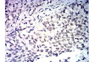 Immunohistochemical analysis of paraffin-embedded bladder cancer tissues using MDM2 mouse mAb with DAB staining. (MDM2 抗体  (AA 26-169))