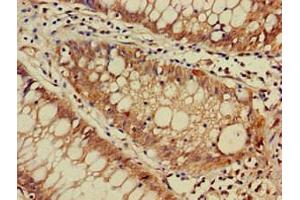 Immunohistochemistry of paraffin-embedded human colon cancer using ABIN7150558 at dilution of 1:100 (DNAJC4 抗体  (AA 1-155))