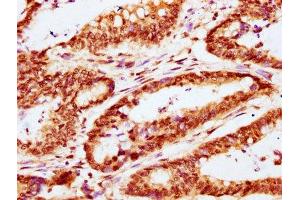 IHC image of ABIN7146274 diluted at 1:400 and staining in paraffin-embedded human colon cancer performed on a Leica BondTM system. (CABIN1 抗体  (AA 1978-2123))