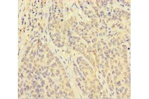 Immunohistochemistry of paraffin-embedded human ovarian cancer using ABIN7162611 at dilution of 1:100 (PAPPA 抗体  (AA 95-302))