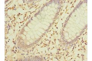 Immunohistochemistry of paraffin-embedded human colon cancer using ABIN7142357 at dilution of 1:100