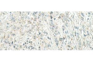 Immunohistochemistry of paraffin-embedded Human breast cancer tissue using UQCC2 Polyclonal Antibody at dilution of 1:60(x200) (MNF1 抗体)