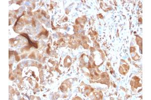Formalin-fixed, paraffin-embedded human Hepatic Carcinoma stained with FABP5 Mouse Monoclonal Antibody (CPTC-FABP5-3). (FABP5 抗体)