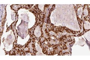 ABIN6267207 at 1/100 staining Human thyroid cancer tissue by IHC-P. (WIPI2 抗体  (pSer413))