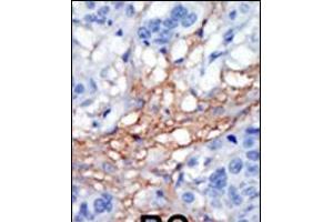 Formalin-fixed and paraffin-embedded human cancer tissue reacted with the primary antibody, which was peroxidase-conjugated to the secondary antibody, followed by AEC staining. (PIP5K1C 抗体  (C-Term))