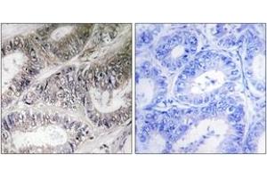 Immunohistochemistry analysis of paraffin-embedded human colon carcinoma tissue, using COX19 Antibody. (COX19 抗体  (AA 10-59))