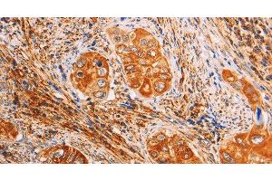 Immunohistochemistry of paraffin-embedded Human cervical cancer using SLC25A4 Polyclonal Antibody at dilution of 1:40 (SLC25A4 抗体)
