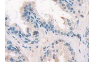 Detection of SOCS2 in Human Prostate Tissue using Polyclonal Antibody to Suppressors Of Cytokine Signaling 2 (SOCS2) (SOCS2 抗体  (AA 1-198))