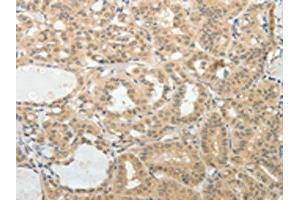 The image on the left is immunohistochemistry of paraffin-embedded Human thyroid cancer tissue using ABIN7189710(AFF2 Antibody) at dilution 1/25, on the right is treated with synthetic peptide. (AFF2 抗体)