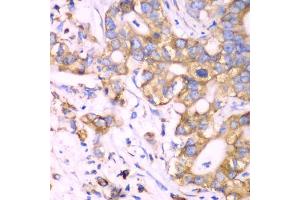 Immunohistochemistry of paraffin-embedded human liver cancer using RPS3A Antibody. (RPS3A 抗体)
