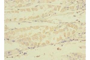 Immunohistochemistry of paraffin-embedded human gastric cancer using  at dilution of 1:100 (TNRC6A 抗体  (AA 1-161))