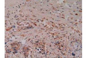 IHC-P analysis of Human Pancreas Cancer Tissue, with DAB staining. (Caspase 8 抗体  (AA 7-216))
