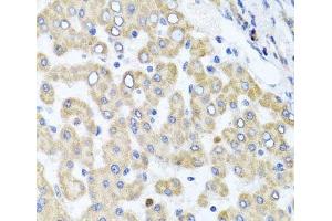 Immunohistochemistry of paraffin-embedded Human liver damage using RAB24 Polyclonal Antibody at dilution of 1:100 (40x lens). (RAB24 抗体)