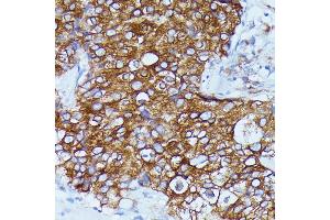 Immunohistochemistry of paraffin-embedded human mammary cancer using DDX6 antibody (ABIN7266704) at dilution of 1:100 (40x lens).