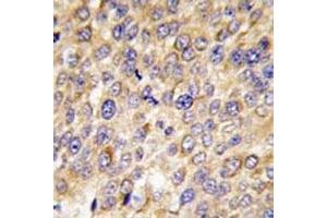 IHC analysis of FFPE human hepatocarcinoma tissue stained with GABARAP antibody