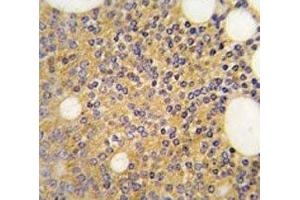 IHC analysis of FFPE human prostate carcinoma tissue stained with PRMT3 antibody (PRMT3 抗体  (AA 460-491))