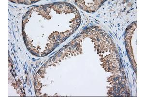 Immunohistochemical staining of paraffin-embedded Adenocarcinoma of Human ovary tissue using anti-TTC32 mouse monoclonal antibody. (TTC32 抗体)