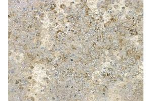 ABIN6259524 and ABIN6273973 at 1/100 staining human melanoma by IHC-P.