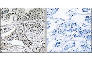 Immunohistochemistry analysis of paraffin-embedded human breast carcinoma tissue, using PLD3 Antibody. (PLD3 抗体  (AA 326-375))