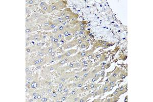 Immunohistochemistry of paraffin-embedded human liver injury using MGAT1 antibody. (MGAT1 抗体)