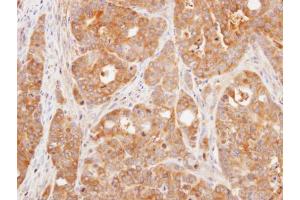 IHC-P Image Immunohistochemical analysis of paraffin-embedded N87 xenograft, using DUSP3, antibody at 1:500 dilution. (Dual Specificity Phosphatase 3 (DUSP3) 抗体)