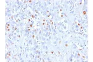 Formalin-fixed, paraffin-embedded human Urothelial carcinoma stained with p21 Mouse Recombinant Monoclonal Antibody (rCIP1/823). (Recombinant p21 抗体)