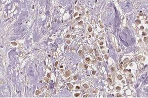 Immunohistochemistry (IHC) image for anti-Estrogen Receptor 1 (ESR1) (pSer167) antibody (ABIN6256169)