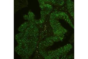 IF analysis of PHF21A using anti-PHF21A antibody (ABIN6719353) PHF21A was detected in paraffin-embedded section of human intestinal cancer tissues. (PHF21A 抗体  (AA 1-97))