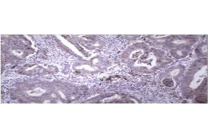 Immunohistochemical staining of paraffin embedded colon carcinoma using MMP9 antibody . (MMP 9 抗体  (C-Term))