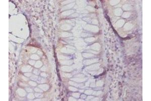 Immunohistochemistry of paraffin-embedded human colon cancer using ABIN7159622 at dilution of 1:20 (MGMT 抗体  (AA 4-207))