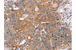 The image on the left is immunohistochemistry of paraffin-embedded Human breast cancer tissue using ABIN7130502(OPTN Antibody) at dilution 1/25, on the right is treated with fusion protein. (OPTN 抗体)