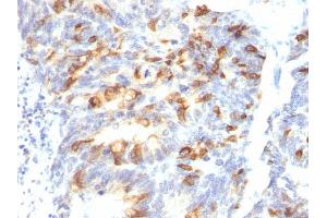 Formalin-fixed, paraffin-embedded human Colon Carcinoma stained with MUC2 Mouse Monoclonal Antibody (MLP/842). (MUC2 抗体)